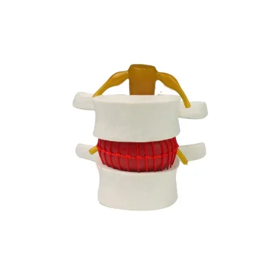 Lumbar Disc Herniation Demonstration Spine Model Plastic PVC Spinal Pathology Model with Herniated Lumbar Vertebrae